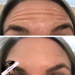 Botox 