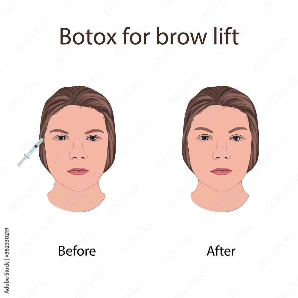 Kaş Kaldırma (Brow Lift)